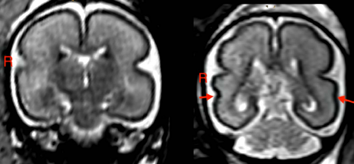  FETAL BRAIN POST-INTRAUTERINE ALCOHOL EXPOSURE IN FETUS BETWEEN 25 AND 29 GESTATIONAL WEEKS. NOTE THE SMOOTH CORTEX IN FRONTOPARIETAL AND TEMPORAL LOBES. RIGHT: BRAIN OF MATCHED HEALTHY CONTROL CASE IN FETUS BETWEEN 25 AND 28 GESTATIONAL WEEKS. THE SUPERIOR TEMPORAL SULCUS IS ALREADY BILATERALLY FORMED (RED ARROWS) AND APPEARS DEEPER ON THE RIGHT HEMISPHERE THAN ON THE LEFT