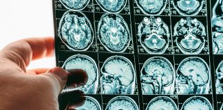brain scan image
