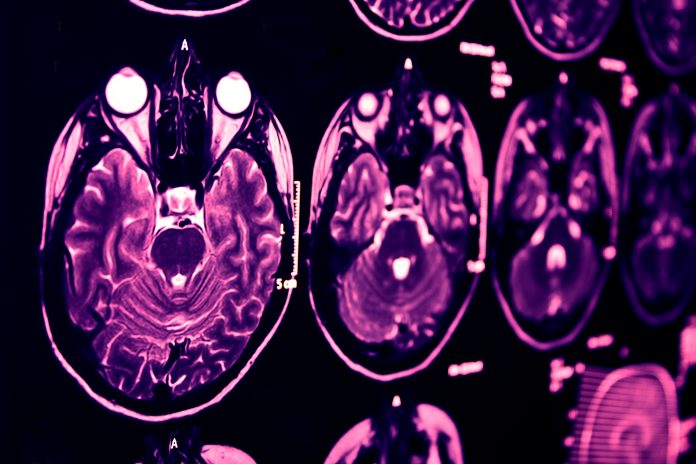 Magnetic Resonance of Brain, blue MR - stroke solutions