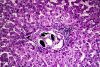 Liver schistosomiasis, light micrograph, parasitic infections