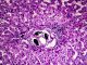 Liver schistosomiasis, light micrograph, parasitic infections