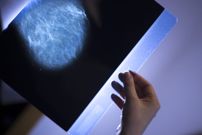 Xray breast scan mammogram