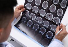 Doctor examining MRI images of patient with multiple sclerosis at white table, closeup