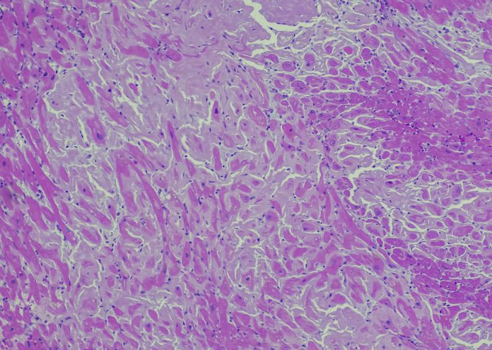 Cardiac amyloidosis is a condition where faulty proteins build up in your heart. You can inherit this condition, or it can develop on its own (usually later in life). As faulty proteins accumulate, your heart struggles to pump, ultimately leading to heart failure and death. amyloid