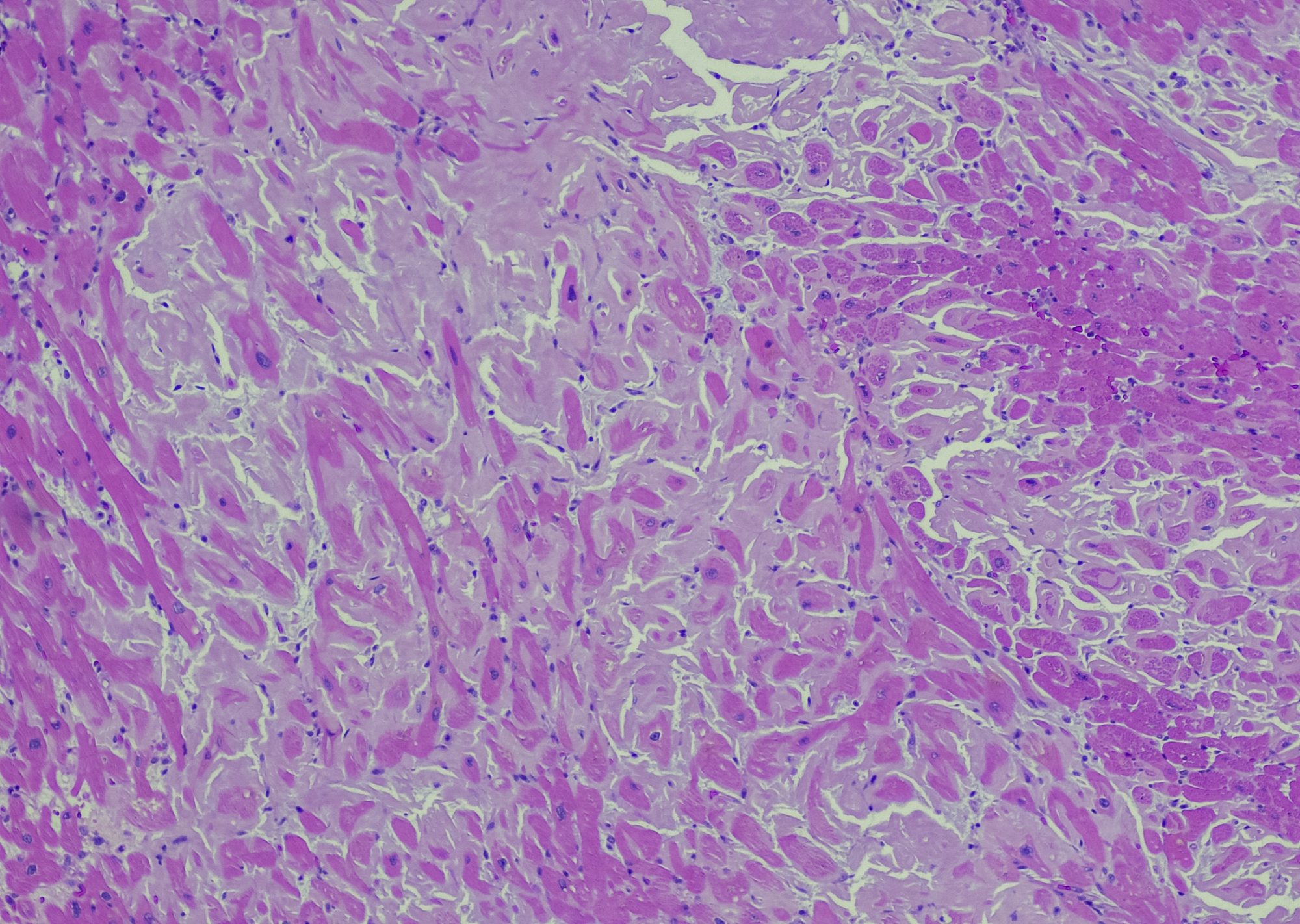 Amyloidosis Spleen