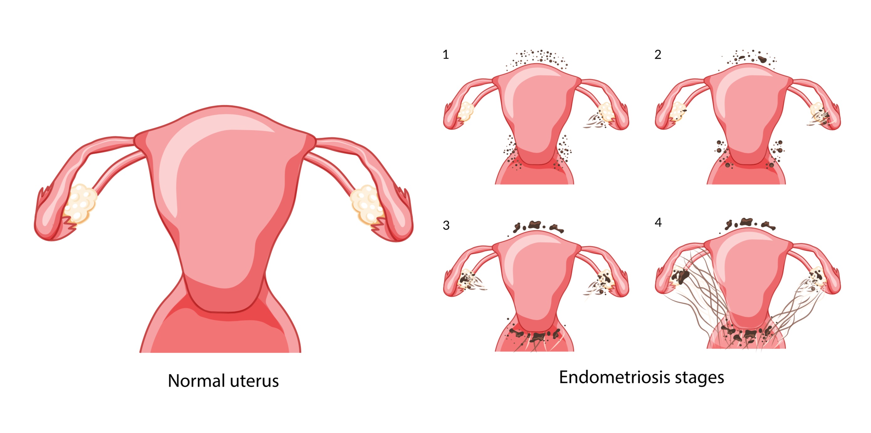 Set of Endometriosis stages Female reproductive system pain pcos tissue cancer cyst uterus