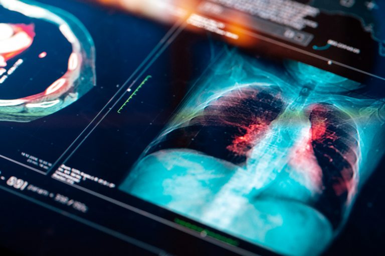 Medical MRI Scan of lungs on a screen