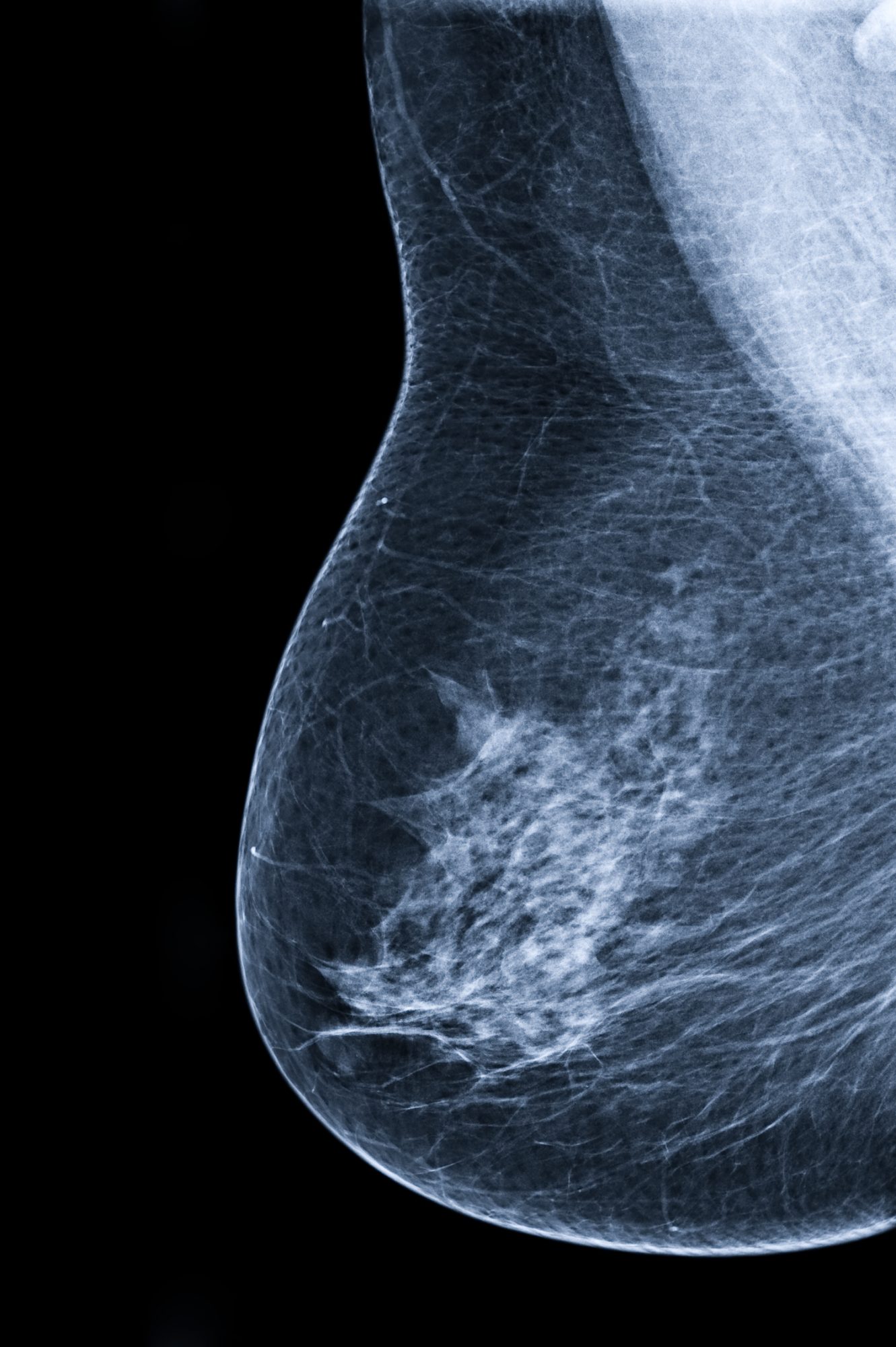 Breast density assessment