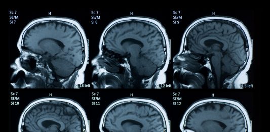 MRI scan of brain