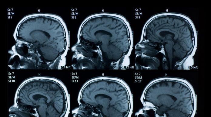 MRI scan of brain