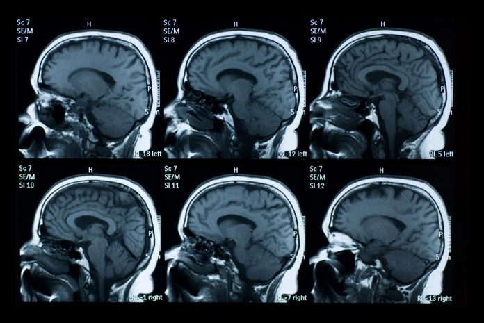 MRI scan of brain