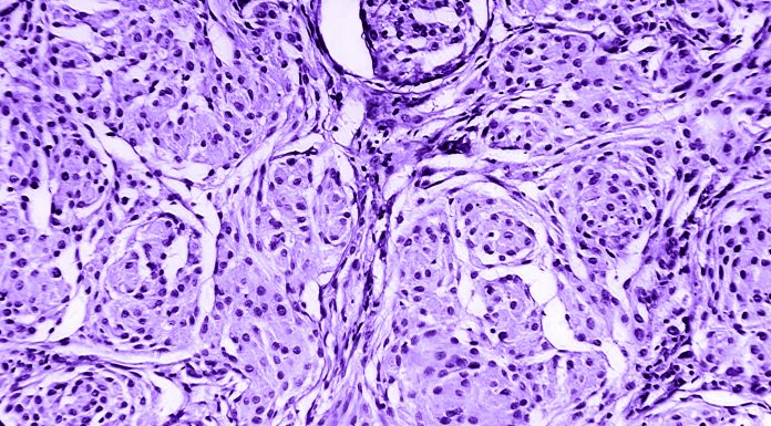 Brain astrocytoma of a human, photomicrograph panorama as seen under the microscope, 200x zoom.