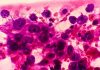 Photomicrograph of Metastatic adenocarcinoma of lung. Pleural fluid FNAC. 200X
