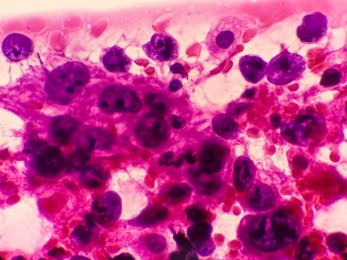 Photomicrograph of Metastatic adenocarcinoma of lung. Pleural fluid FNAC. 200X