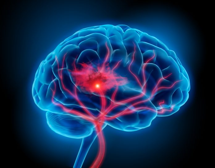 Illustration of human brain with stroke symptom