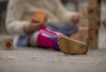 girl with a prosthetic leg