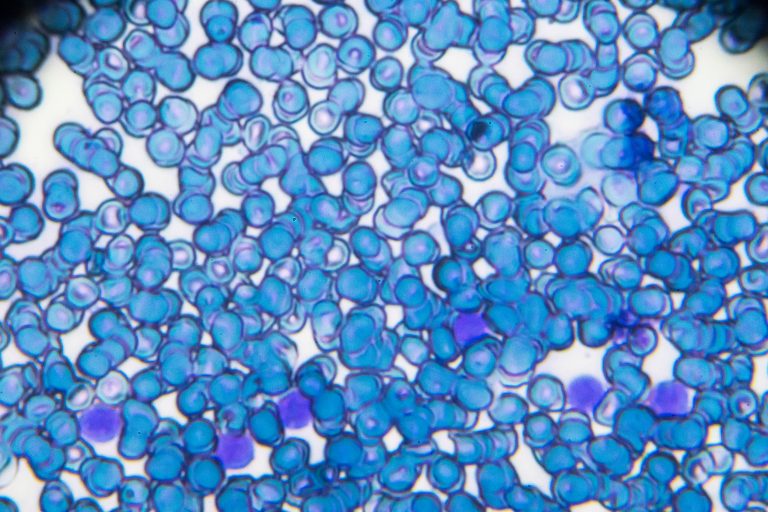 Acute lymphoblastic leukemia ALL-L2 blood smear under light microscopy, cancer cells