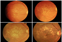 There is time to intervene in AMD before end-stage disease occurs