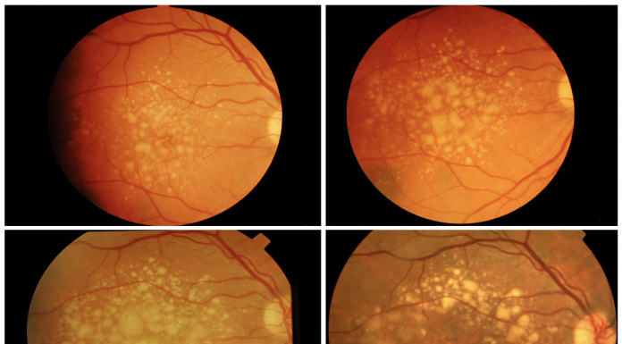 There is time to intervene in AMD before end-stage disease occurs