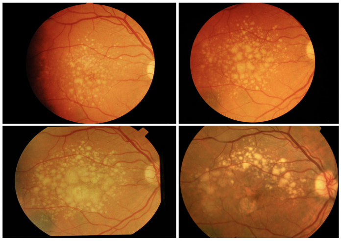 There is time to intervene in AMD before end-stage disease occurs