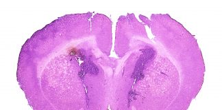 Mid-section of a mouse brain with developed glioblastoma tumor - dyscolored spot in the left hemisphere.