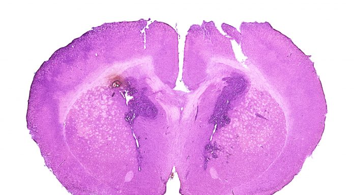 Mid-section of a mouse brain with developed glioblastoma tumor - dyscolored spot in the left hemisphere.