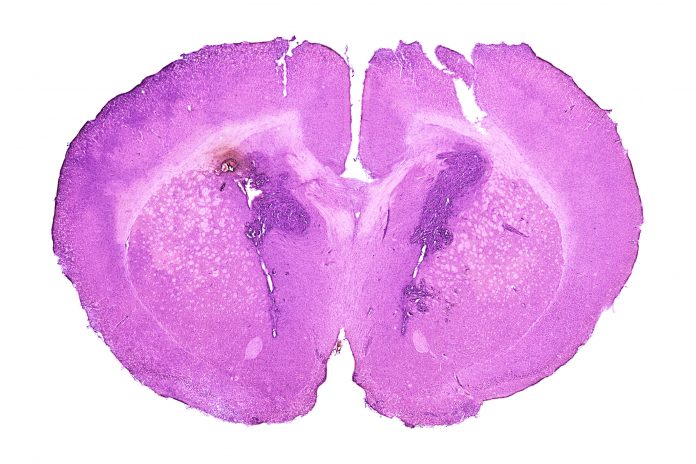 Mid-section of a mouse brain with developed glioblastoma tumor - dyscolored spot in the left hemisphere.