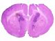 Mid-section of a mouse brain with developed glioblastoma tumor - dyscolored spot in the left hemisphere.