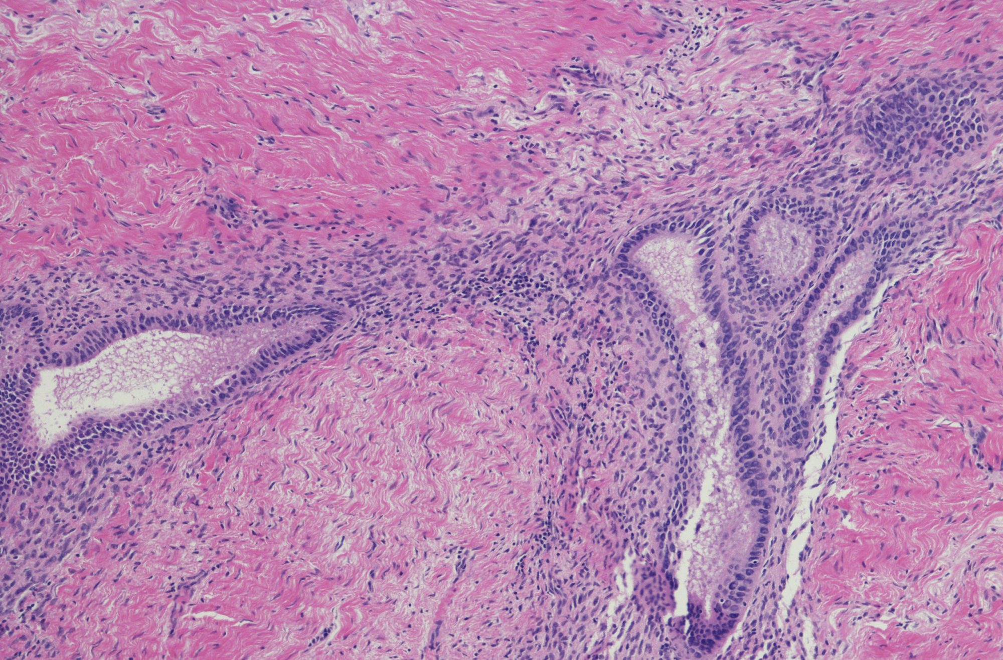 Endometriozis oluşumundan iğsi bakteriler sorumlu mudur?