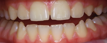 Fig 1a and 1b: Microscopic view of the natural roughness of enamel on the bacteria level