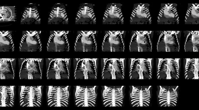 Thoracoabdominal CT