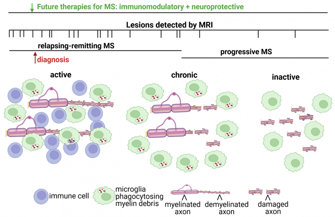 Figure 1: Immunomodulatory therapies are effective during the relapsing-remitting phase of MS, when immune cells are found in active lesions, but fail to ameliorate progressive decline and irreversible clinical disability. Increased axonal injury correlates with lack of immune cell infiltration but sustained activation of resident CNS glial cells in the progressive phase. These pathological findings are consistent with MRI imaging studies demonstrating virtually no new lesions occurring during progressive MS. Additionally, at the time of MS diagnosis there is evidence of prior lesion activity by MRI imaging supporting that the future development of neuroprotective strategies should be administered in combination with immunomodulatory therapies.