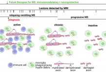 Figure 1: Immunomodulatory therapies are effective during the relapsing-remitting phase of MS, when immune cells are found in active lesions, but fail to ameliorate progressive decline and irreversible clinical disability. Increased axonal injury correlates with lack of immune cell infiltration but sustained activation of resident CNS glial cells in the progressive phase. These pathological findings are consistent with MRI imaging studies demonstrating virtually no new lesions occurring during progressive MS. Additionally, at the time of MS diagnosis there is evidence of prior lesion activity by MRI imaging supporting that the future development of neuroprotective strategies should be administered in combination with immunomodulatory therapies.