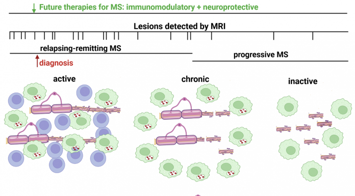 Figure 1: Immunomodulatory therapies are effective during the relapsing-remitting phase of MS, when immune cells are found in active lesions, but fail to ameliorate progressive decline and irreversible clinical disability. Increased axonal injury correlates with lack of immune cell infiltration but sustained activation of resident CNS glial cells in the progressive phase. These pathological findings are consistent with MRI imaging studies demonstrating virtually no new lesions occurring during progressive MS. Additionally, at the time of MS diagnosis there is evidence of prior lesion activity by MRI imaging supporting that the future development of neuroprotective strategies should be administered in combination with immunomodulatory therapies.