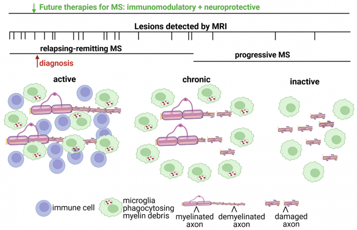 Figure 1: Immunomodulatory therapies are effective during the relapsing-remitting phase of MS, when immune cells are found in active lesions, but fail to ameliorate progressive decline and irreversible clinical disability. Increased axonal injury correlates with lack of immune cell infiltration but sustained activation of resident CNS glial cells in the progressive phase. These pathological findings are consistent with MRI imaging studies demonstrating virtually no new lesions occurring during progressive MS. Additionally, at the time of MS diagnosis there is evidence of prior lesion activity by MRI imaging supporting that the future development of neuroprotective strategies should be administered in combination with immunomodulatory therapies.