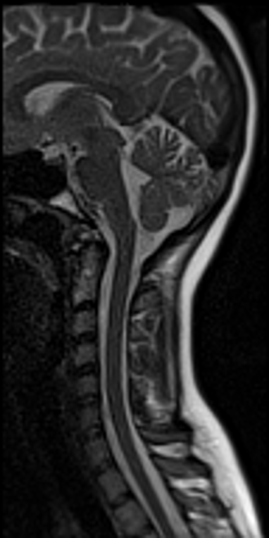 Figure 1: Example of functional MRI data spanning the brainstem and spinal cord using methods developed by P. Stroman.