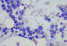 Microscopic photo of a professionally prepared slide demonstrating Plasma cell myeloma from bone marrow aspirate. Wright Giemsa stain.