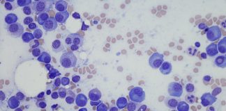 Microscopic photo of a professionally prepared slide demonstrating Plasma cell myeloma from bone marrow aspirate. Wright Giemsa stain.