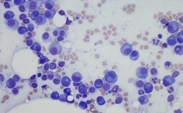 Microscopic photo of a professionally prepared slide demonstrating Plasma cell myeloma from bone marrow aspirate. Wright Giemsa stain.