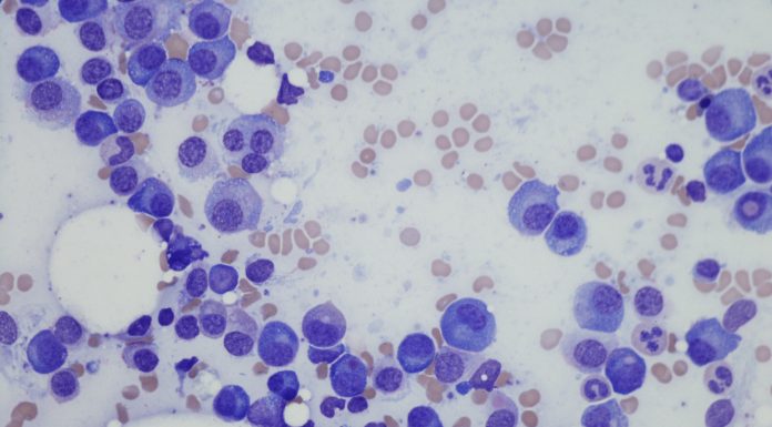 Microscopic photo of a professionally prepared slide demonstrating Plasma cell myeloma from bone marrow aspirate. Wright Giemsa stain.