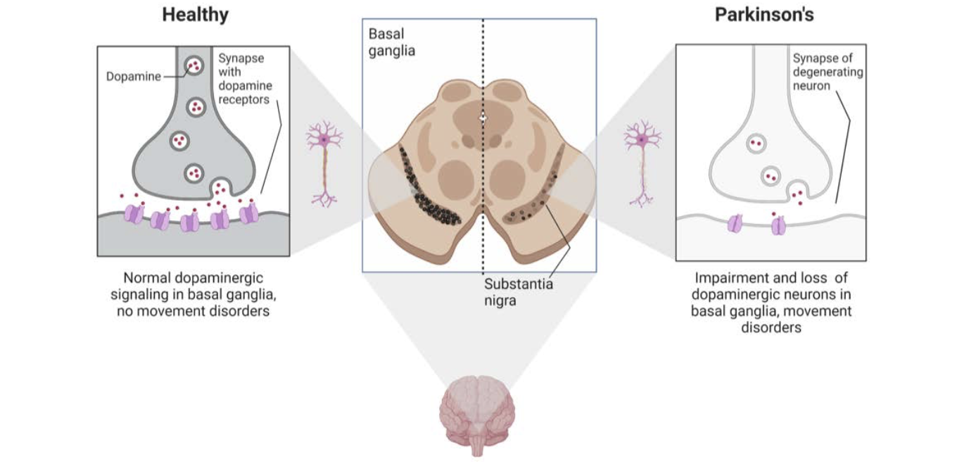 Figure 1. The progression of Parkinson’s Disease in the substantia nigra, a region of the brain that controls movement. The left side of the figure illustrates the density of dopamine, dopamine receptors and dopaminergic neurons in a healthy adult brain; the right side, the brain of a patient with Parkinson’s. Created using BioRender.com.