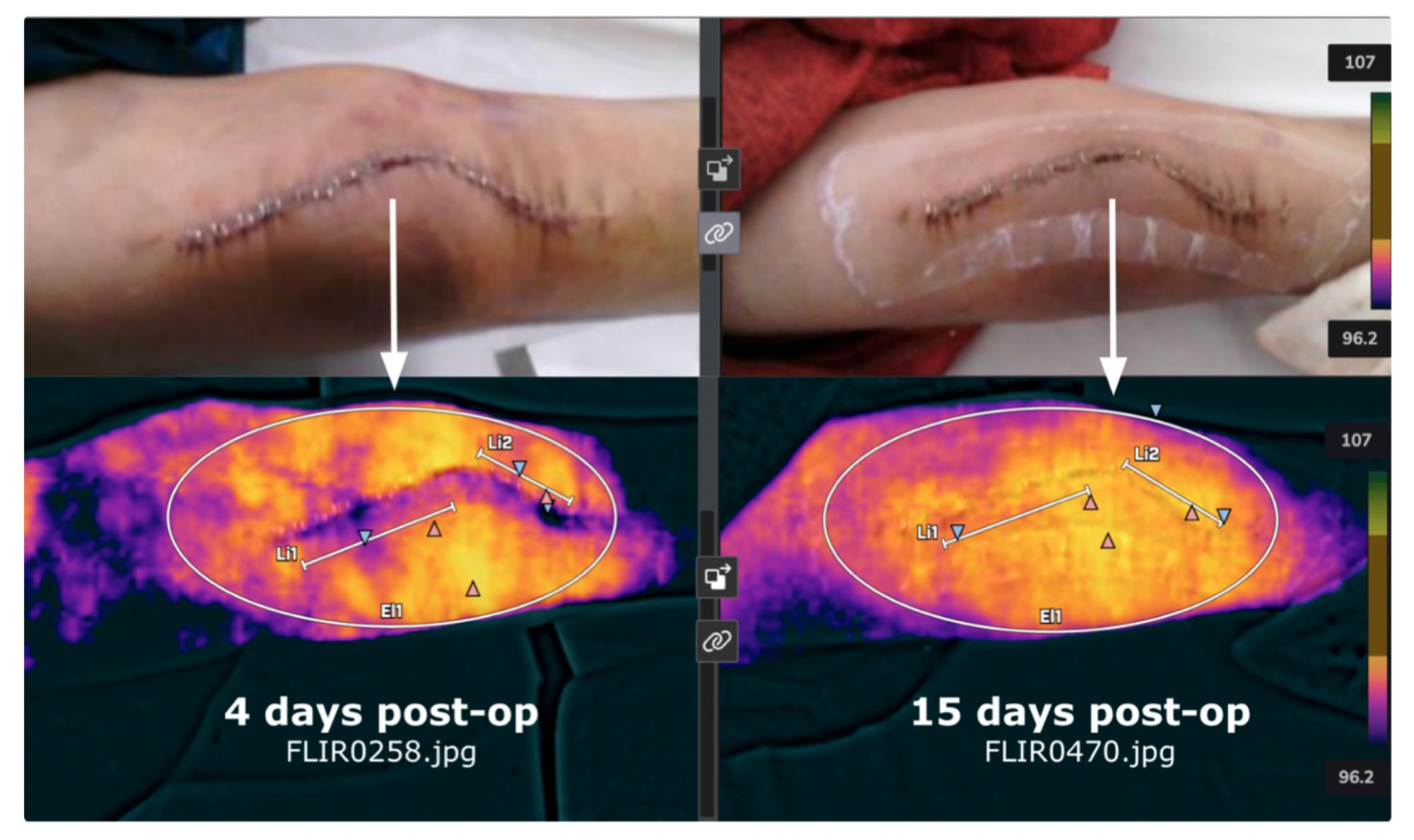 Figure 5: Truss Medical is exploring how thermal scans can diagnosis proper wound healing, infection, and/or inflammation surrounding an implant. This particular example is using thermal scans to determine if infection or inflammation (which would raise temperatures) is occurring surrounding a patient’s knee implant. Further, AI is being incorporated into such thermal data to predict the chances of infection and/or inflammation surrounding medical device surgery