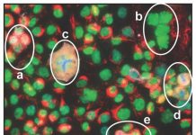 Figure 1: Immunofluorescent image of OVCAR3 cells in culture showing that cells are at different stages of the cell cycle. P53 (green) is nuclear in all cells that are not dividing, including PGCCs that are multinuclear (a) and (b). PGCC during abnormal cytokinesis (c). P53 is redistributed in cells undergoing normal mitosis where the condensed chromosomes are either at the midbody (d) or are undergoing cytokinesis (e). (1)