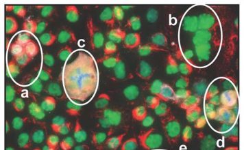 Figure 1: Immunofluorescent image of OVCAR3 cells in culture showing that cells are at different stages of the cell cycle. P53 (green) is nuclear in all cells that are not dividing, including PGCCs that are multinuclear (a) and (b). PGCC during abnormal cytokinesis (c). P53 is redistributed in cells undergoing normal mitosis where the condensed chromosomes are either at the midbody (d) or are undergoing cytokinesis (e). (1)