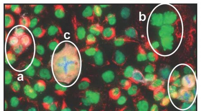 Figure 1: Immunofluorescent image of OVCAR3 cells in culture showing that cells are at different stages of the cell cycle. P53 (green) is nuclear in all cells that are not dividing, including PGCCs that are multinuclear (a) and (b). PGCC during abnormal cytokinesis (c). P53 is redistributed in cells undergoing normal mitosis where the condensed chromosomes are either at the midbody (d) or are undergoing cytokinesis (e). (1)