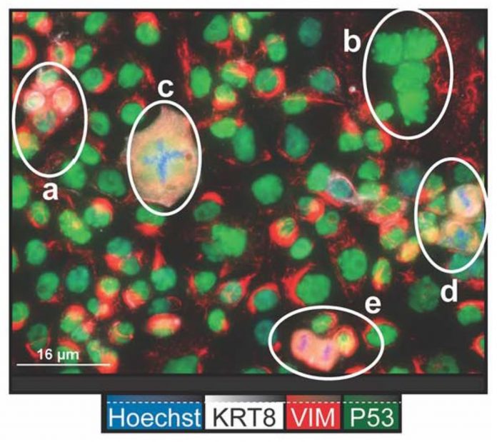 Figure 1: Immunofluorescent image of OVCAR3 cells in culture showing that cells are at different stages of the cell cycle. P53 (green) is nuclear in all cells that are not dividing, including PGCCs that are multinuclear (a) and (b). PGCC during abnormal cytokinesis (c). P53 is redistributed in cells undergoing normal mitosis where the condensed chromosomes are either at the midbody (d) or are undergoing cytokinesis (e). (1)