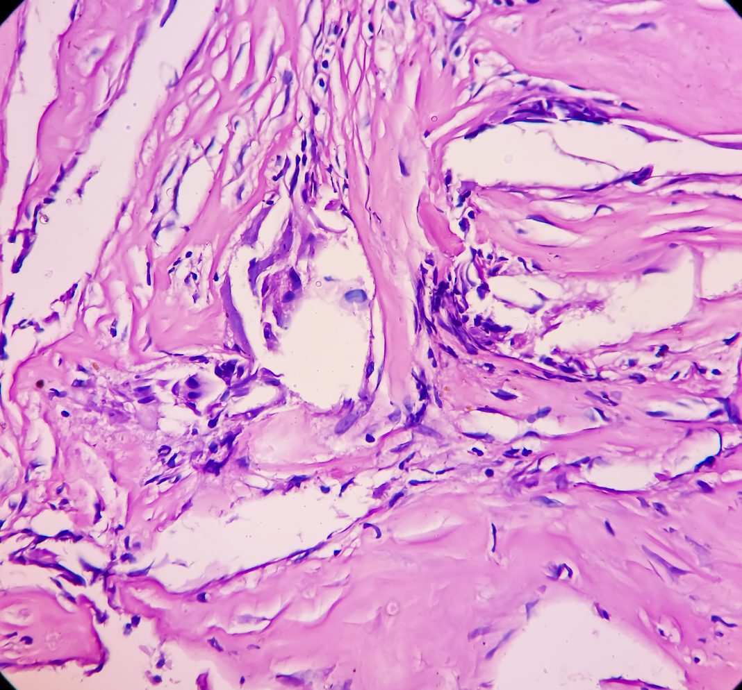 Tissue from sellar lesion, microscopy show multiple wet keratin, basaloid appearing cells, inflammatory cells and giant cells. Diagnosis Craniopharyngioma.