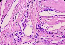 Tissue from sellar lesion, microscopy show multiple wet keratin, basaloid appearing cells, inflammatory cells and giant cells. Diagnosis Craniopharyngioma.