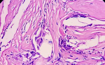 Tissue from sellar lesion, microscopy show multiple wet keratin, basaloid appearing cells, inflammatory cells and giant cells. Diagnosis Craniopharyngioma.