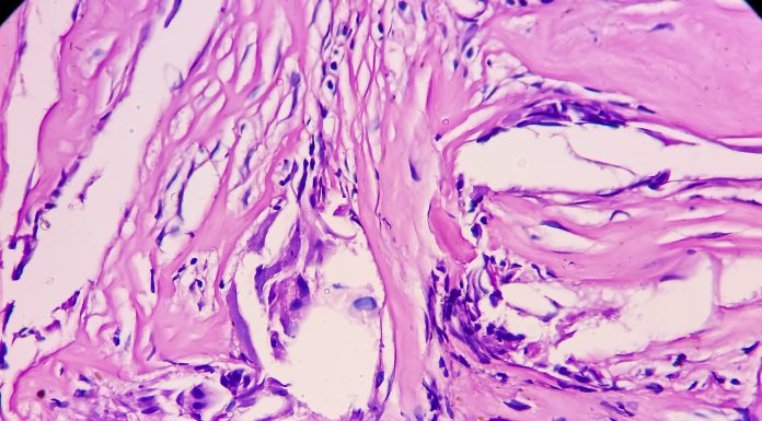 Tissue from sellar lesion, microscopy show multiple wet keratin, basaloid appearing cells, inflammatory cells and giant cells. Diagnosis Craniopharyngioma.